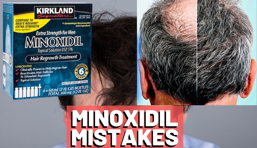 minoxidil prescription mistakes for women with hair loss issues